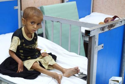Afganistán, infancia, desnutrición, aguda