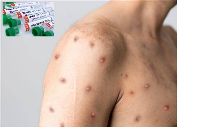 Confirma-Sao-Paulo-primer-caso-viruela-del-mono-en-Brasil-Small