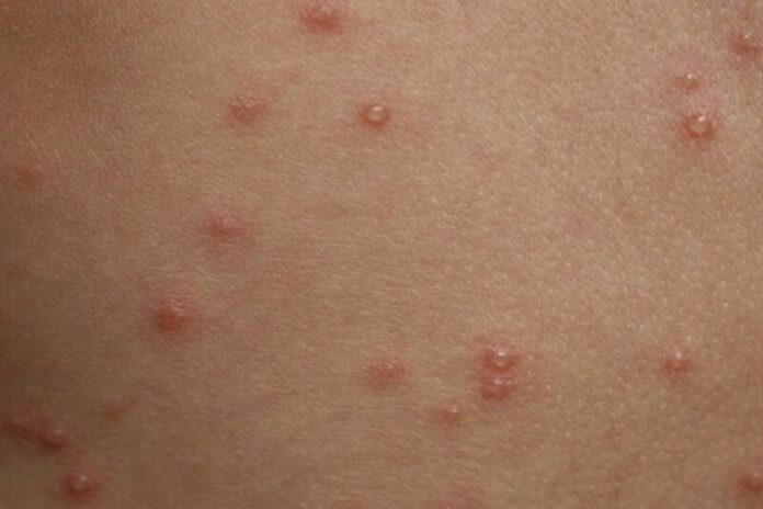 Europa, viruela, símica, casos