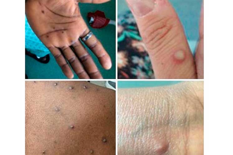 Europa-OMS-viruela-del-mono