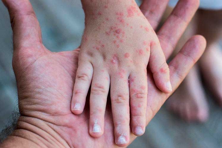 Mexico reports 60 monkeypox cases