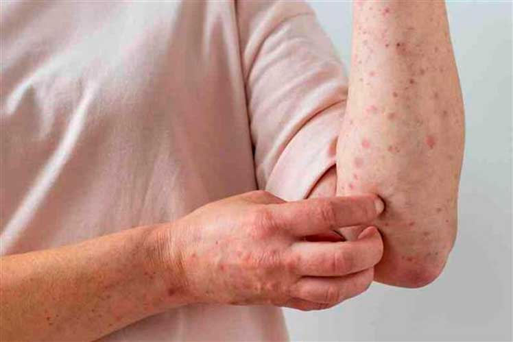 Colombia-casos-viruela