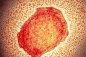 Virus-Viruela-Mono-300x200