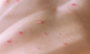 dominican-republic-reports-12-monkeypox-cases