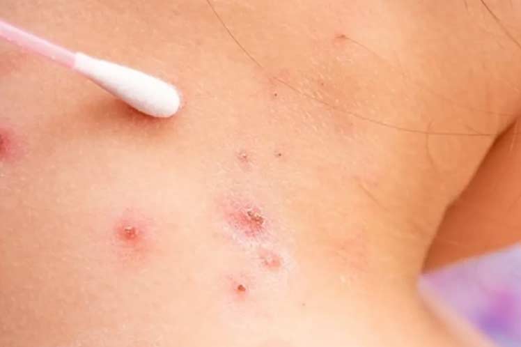 guatemala-reports-14-new-monkeypox-cases