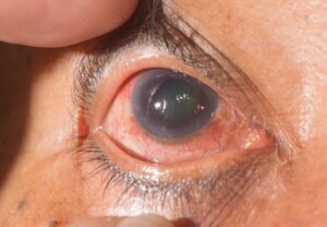 glaucoma-768x532-1