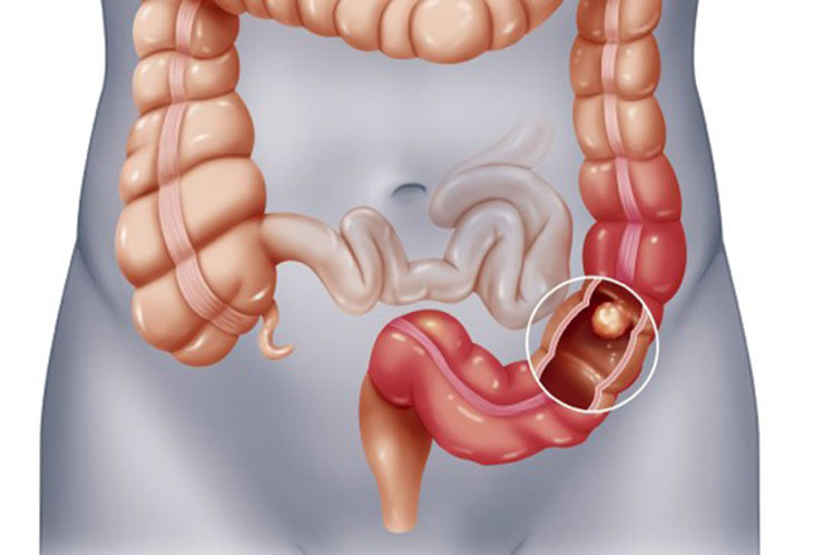 Cancer-colorrectal