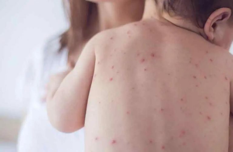 sarampion-armenia-ninos-1-768x502