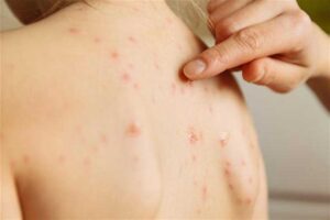 paraguay-outbreak-of-chickenpox-among-children